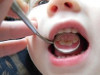 Как развивается кариес молочных зубов?