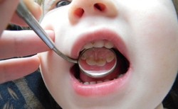 Как развивается кариес молочных зубов?